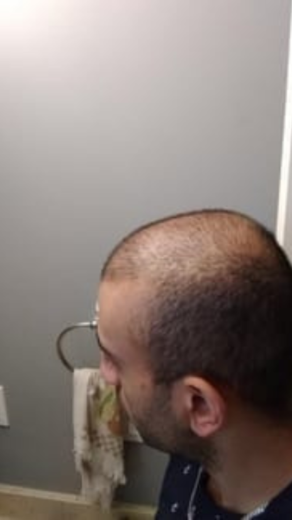 Before - Ahmed