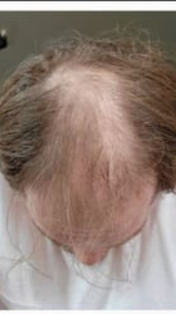 Before - Marcus